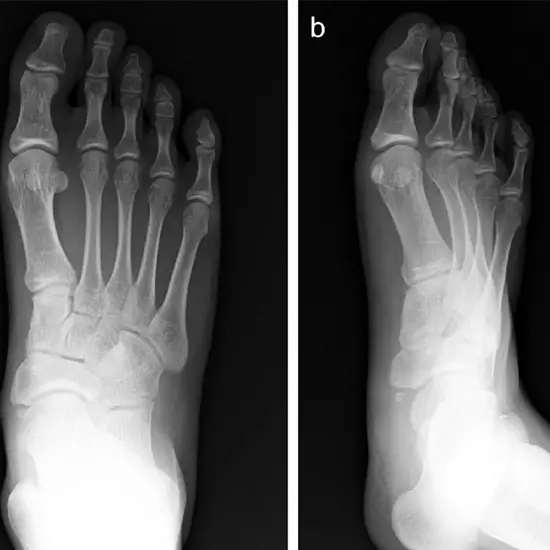 X-ray Right Toes AP & Oblique Views